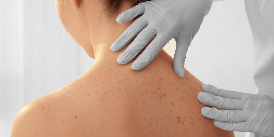 Hautkrebs-Screening & Hautkrebsvorsorge in Hamburg